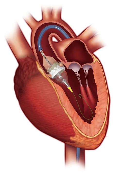 rundown  minimally invasive heart valve repair  replacement