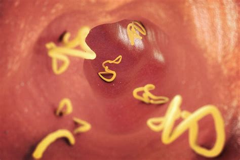 Cómo tratar las lombrices intestinales - Mejor con Salud