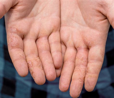 Dyshidrotic Eczema And Stress at Laura Perry blog