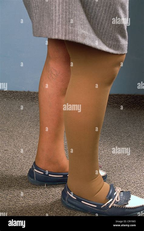 Leg Edema Medical Term at Joseph Russo blog