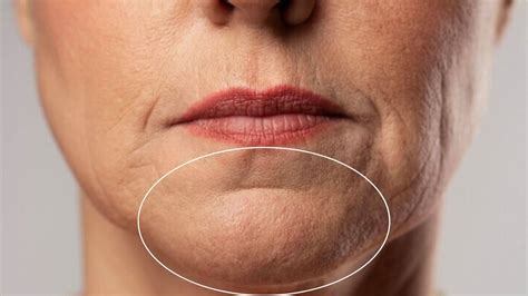 chin wrinkles beauty enhancement services swindon