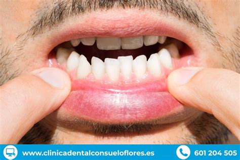 El apiñamiento dental. - Clínica Dental Consuelo Flores en San Vicente ...