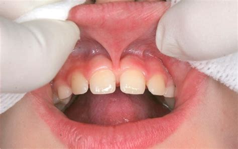 Лазерное подрезание уздечки - KOVALENKO Aesthetic Dental Clinic
