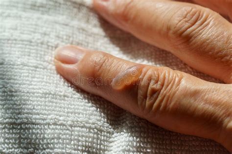 Dedo Inflamado Água Quente Com Sal - Blister No Dedo De Queimadura Térmica Com água Fervente. Mão De Mulher ...