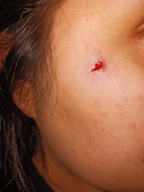 Can Piercers Remove Embedded Piercings at Eileen Perry blog