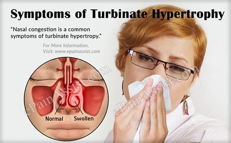 Turbinate Hypertrophy|Causes|Symptoms|Diagnosis