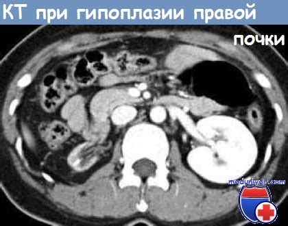 Гипоплазия почек - причины, диагностика