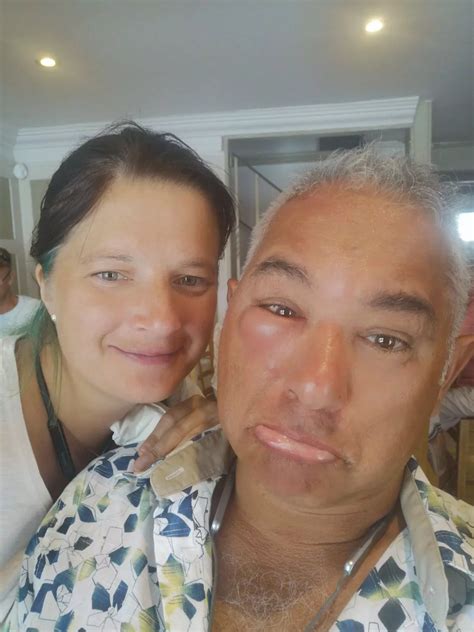 Sleeping camper bitten by poisonous UK snake blames wife as fangs