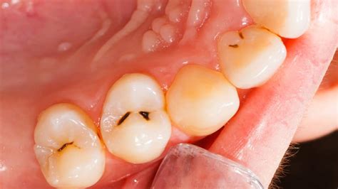 Omega Dental: Rotten Tooth Symptoms & Treatment Guide | Blog