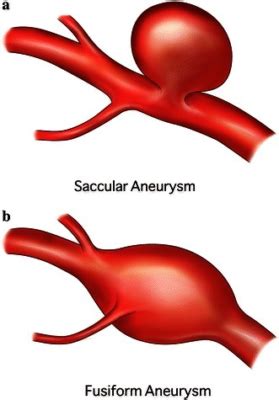 Brain Aneurysm Treatment - Neurosurgery