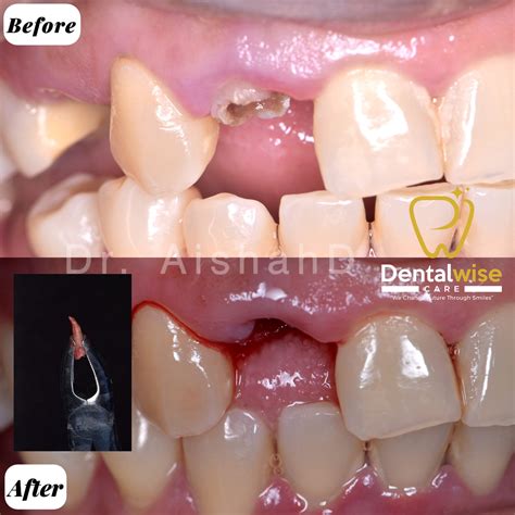 Extraction - Dentalwise Care