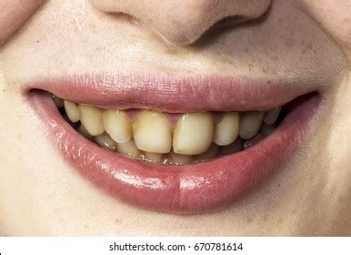 "dirty_teeth" Images, Stock Photos & Vectors | Shutterstock