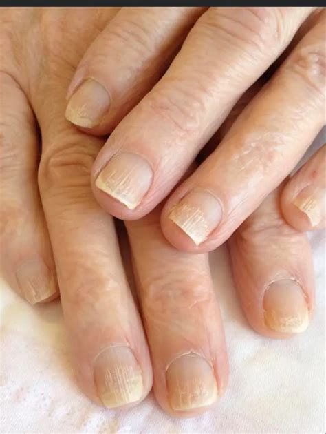 Introduction to Nail Conditions - NailKnowledge