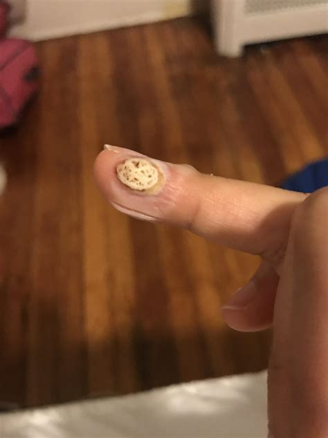 You guys I think home remedies are angering my wart and making it worse