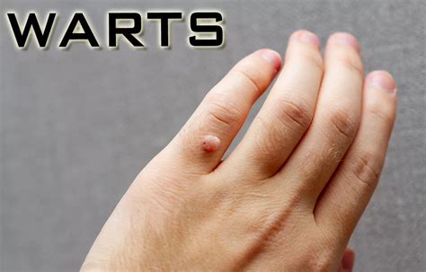 tazarotene  imiquimod offer similar efficacy  treating plane warts