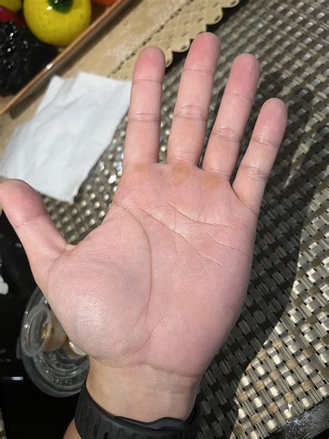 29M, why are the lines on my two different palms distinct? Is this