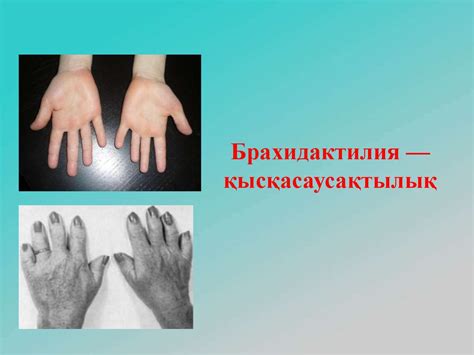 Брахидактилия - қысқасаусақтылық - презентация онлайн