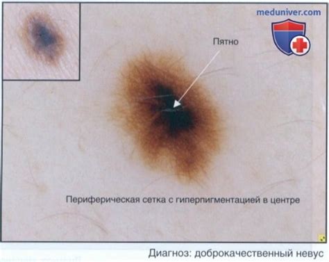 Диагностическая дерматоскопия - алгоритм, этапы