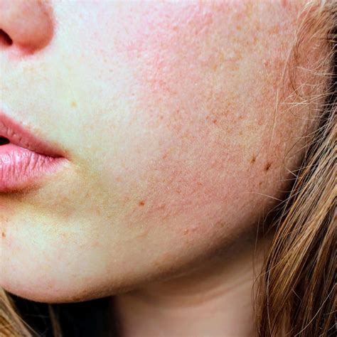 Itchy Rash On Face