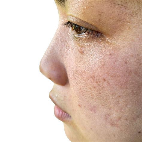 Laser for Melasma