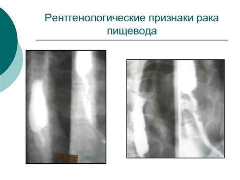 Рак пищевода и желудка Актуальность