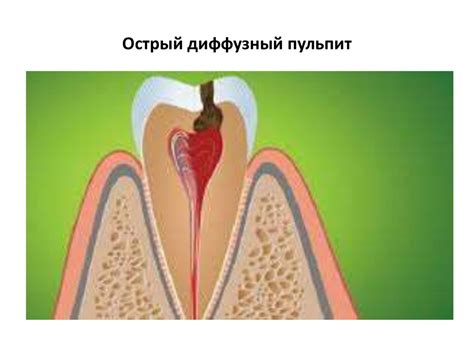 Пульпит временных и постоянных зубов у детей - презентация онлайн