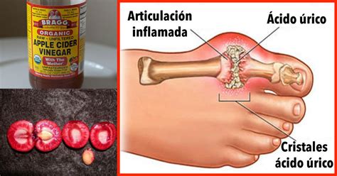 Cómo eliminar rápidamente la cristalización de ácido úrico de su cuerpo ...
