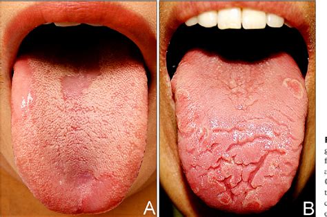 Reasons For Geographic Tongue How To Treat It