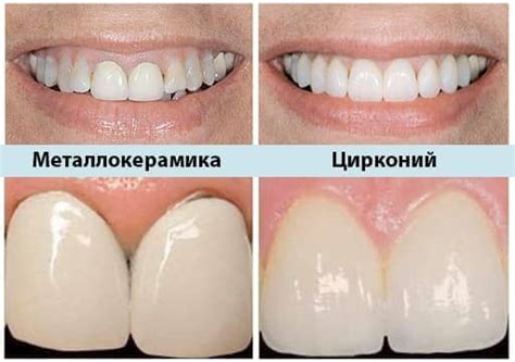 Металлокерамические коронки для зубов в Минске, цены, установка ...