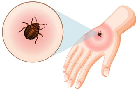 Lyme Disease Symptoms: Identifying Common Signs to Watch For - HosTalky