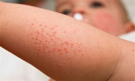 Alergia Ao Suor Em Bebe