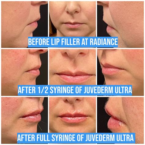 Enhance Your Lips with Stunning Lip Filler Results