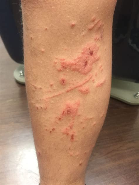 Allergic Contact Dermatitis | Pennsylvania Dermatology Specialists