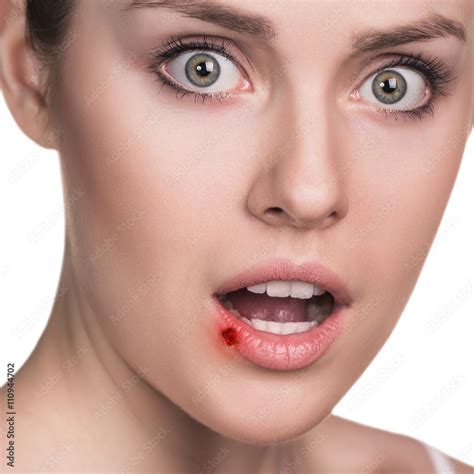 Sore on the female lips Stock Photo | Adobe Stock