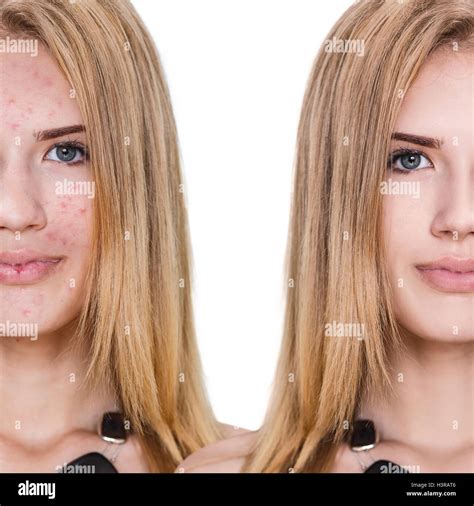 Girl with acne before and after treatment Stock Photo - Alamy