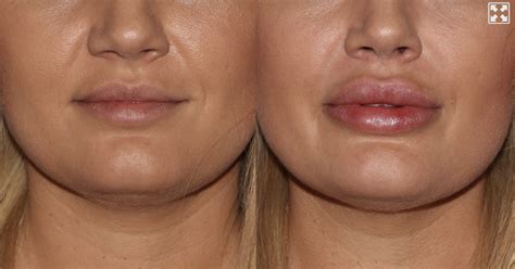 restylane voluma  lips lipstutorialorg