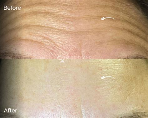 wrinkle reduction treatment queensland skin  laser