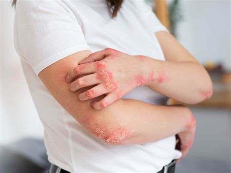 Ayurvedic treatment of Fungal Infection