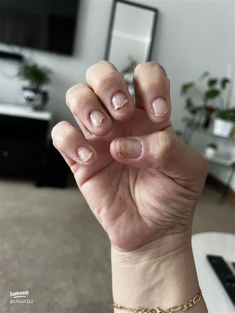 What causes allergic reactions to nail polish? | 2024 real user