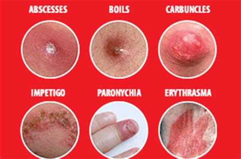 bacterial infection names