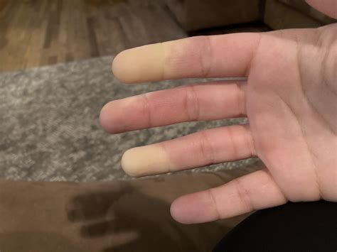My fingers are numb what’s wrong with them? : r/medizzy