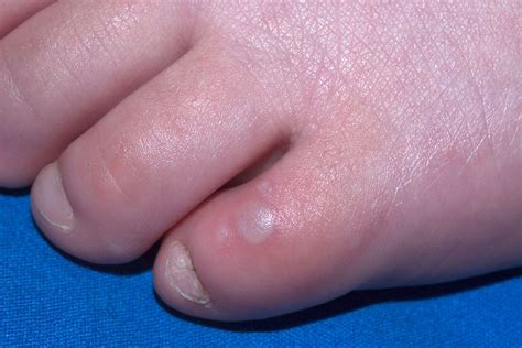 Hand, Foot and Mouth Disease - The Children's Medic