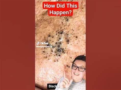 Warning: This Unbelievable Blackhead Removal Method is Going Viral (2024) - ci995ze