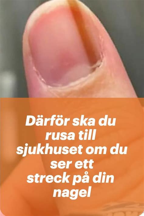 daerfoer ska du rusa  sjukhuset om du ser ett streck pa din nagel