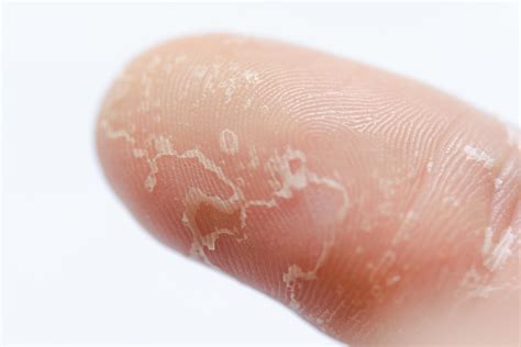 Peeling skin on hand and fingers. Desquamation 6663185 Stock Photo at