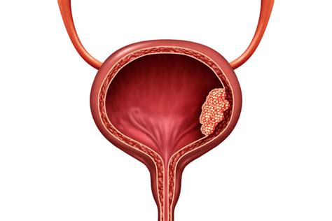gu ohio urology bladder biopsy  fulguration