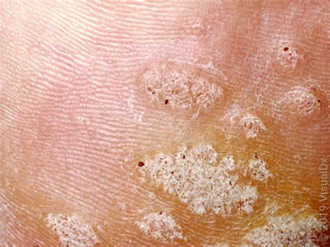 warts    women infoupdateorg