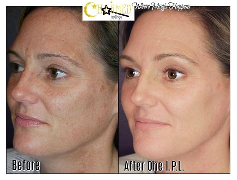 intense pulsed light laser therapies charmed medispa