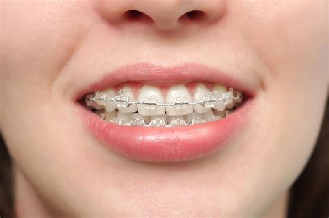 types  braces trusted orthodontist  texas