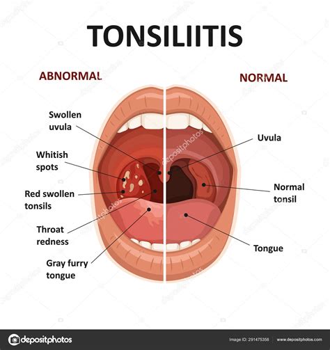 Tonsils and throat diseases. Tonsillitis symptoms. Anatomy of human ...